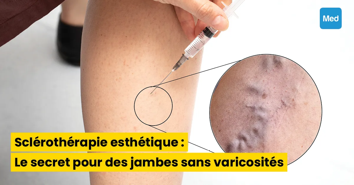 Sclérothérapie esthétique : Le secret pour des jambes sans varicosités